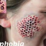 Qu'est-ce que la trypophobie?  Causes, remèdes et faits des maladies de la peau

 - Comment guérir
