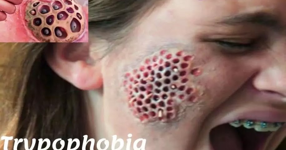 Qu&rsquo;est-ce que la trypophobie?  Causes, remèdes et faits des maladies de la peau– Comment guérir